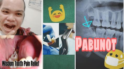 bunot ng ngipin in english dental term|Tooth Extractions .